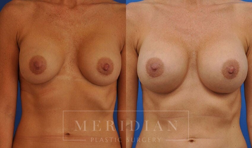 tjelmeland-meridian-austin-breast-revision-patient-10-1