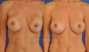 tjelmeland-meridian-austin-breast-revision-patient-2-1