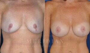 tjelmeland-meridian-austin-breast-revision-patient-3-1