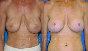 tjelmeland-meridian-austin-breast-revision-patient-4-1