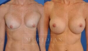 tjelmeland-meridian-austin-breast-revision-patient-5-1