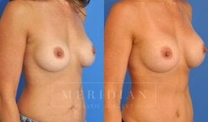 tjelmeland-meridian-austin-breast-revision-patient-6-2