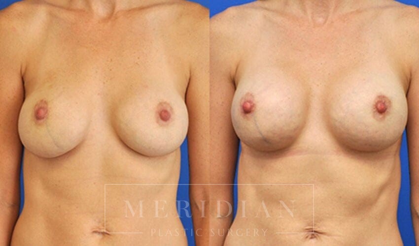 tjelmeland-meridian-austin-breast-revision-patient-8-1