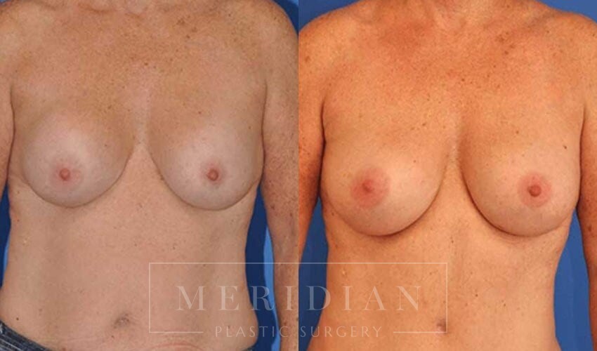 tjelmeland-meridian-austin-breast-revision-patient-9-1