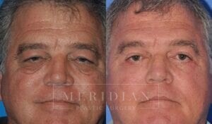 tjelmeland-meridian-austin-eyelid-lift-patient-5-1
