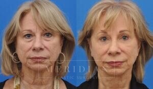 tjelmeland-meridian-austin-eyelid-lift-patient-7-1