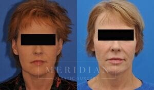 tjelmeland-meridian-austin-facelift-patient-15-1