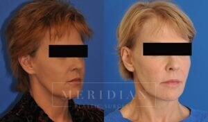 tjelmeland-meridian-austin-facelift-patient-15-2