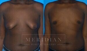tjelmeland-meridian-austin-gynecomastia-patient-1-1