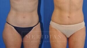 tjelmeland-meridian-austin-liposuction-patient-1-1