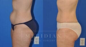 tjelmeland-meridian-austin-liposuction-patient-1-2