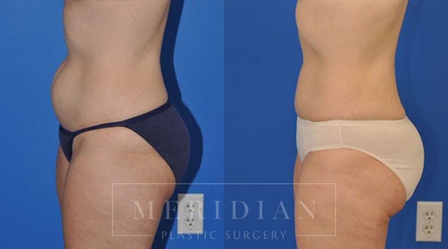 OR Snapshots - Abdominal and Flank Liposuction - Explore Plastic Surgery