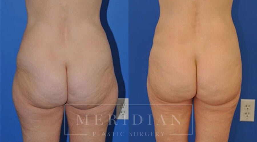 Upper and Lower Abdomen and Flank Liposuction, Inner and Outer Thigh  Liposuction with Fat Transfer to Buttocks - Terrell Clinic
