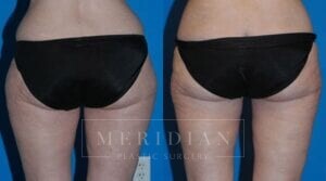 tjelmeland-meridian-austin-liposuction-patient-12-1