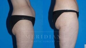 tjelmeland-meridian-austin-liposuction-patient-12-2