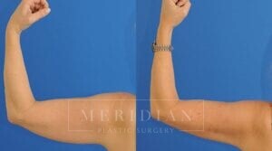 tjelmeland-meridian-austin-liposuction-patient-13-1