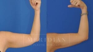 tjelmeland-meridian-austin-liposuction-patient-13-2