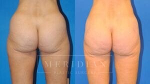 tjelmeland-meridian-austin-liposuction-patient-14-2