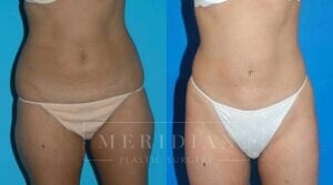 tjelmeland-meridian-austin-liposuction-patient-15-1