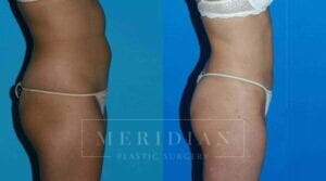 tjelmeland-meridian-austin-liposuction-patient-15-2