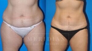 tjelmeland-meridian-austin-liposuction-patient-16-1