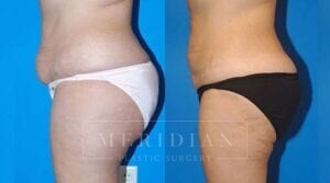 tjelmeland-meridian-austin-liposuction-patient-16-2