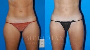 tjelmeland-meridian-austin-liposuction-patient-17-1