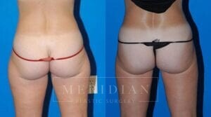 tjelmeland-meridian-austin-liposuction-patient-17-2