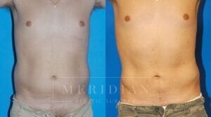 tjelmeland-meridian-austin-liposuction-patient-19-1