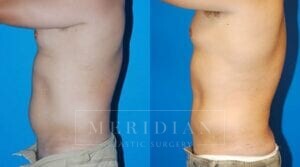 tjelmeland-meridian-austin-liposuction-patient-19-2
