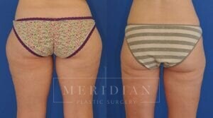 tjelmeland-meridian-austin-liposuction-patient-2-2