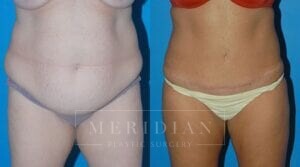 tjelmeland-meridian-austin-liposuction-patient-20-1