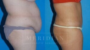 tjelmeland-meridian-austin-liposuction-patient-20-2