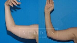 tjelmeland-meridian-austin-liposuction-patient-21-1