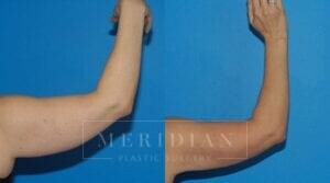 tjelmeland-meridian-austin-liposuction-patient-21-2
