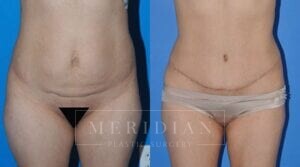 tjelmeland-meridian-austin-liposuction-patient-22-1