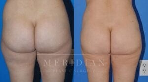 tjelmeland-meridian-austin-liposuction-patient-22-2