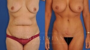 tjelmeland-meridian-austin-liposuction-patient-23-1