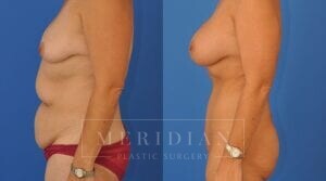 tjelmeland-meridian-austin-liposuction-patient-23-2