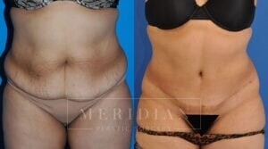 tjelmeland-meridian-austin-liposuction-patient-24-1