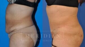 tjelmeland-meridian-austin-liposuction-patient-24-2