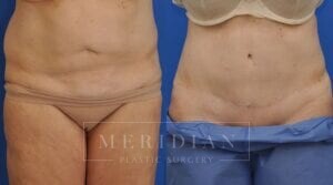 tjelmeland-meridian-austin-liposuction-patient-25-1
