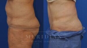 tjelmeland-meridian-austin-liposuction-patient-25-2