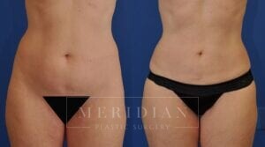 tjelmeland-meridian-austin-liposuction-patient-26-1