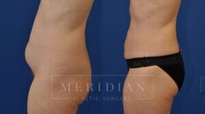 tjelmeland-meridian-austin-liposuction-patient-26-2