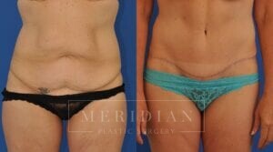 tjelmeland-meridian-austin-liposuction-patient-27-1