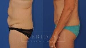 tjelmeland-meridian-austin-liposuction-patient-27-2