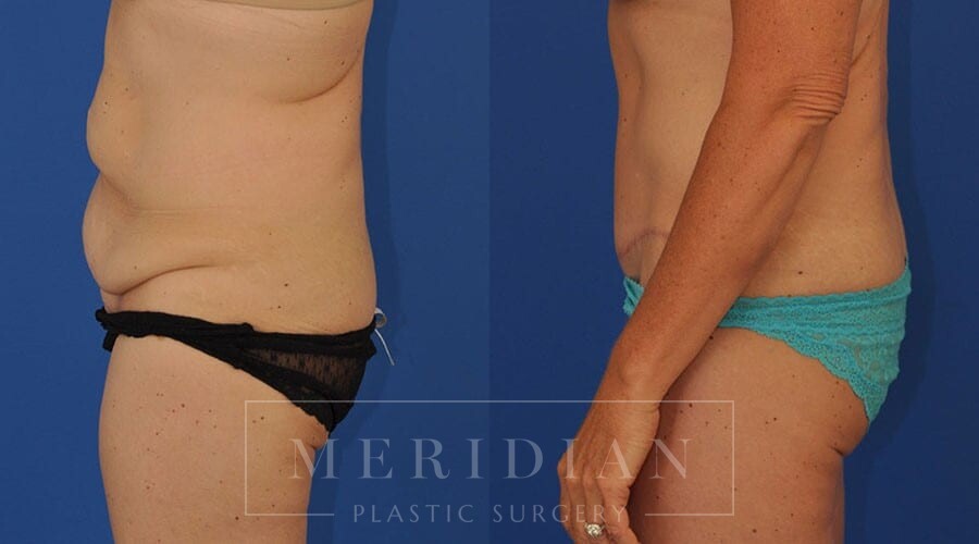 tjelmeland-meridian-austin-liposuction-patient-27-2