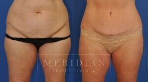 tjelmeland-meridian-austin-liposuction-patient-28-1