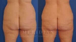 tjelmeland-meridian-austin-liposuction-patient-28-2